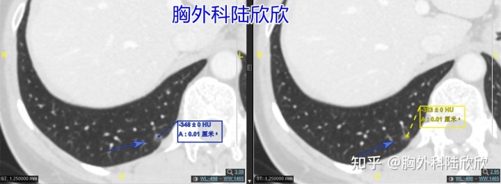 中年女性发现磨玻璃结节1年，住院后直接住院