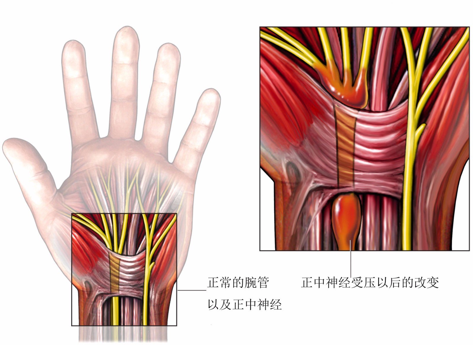 4手指无力无法伸直，手指活动障碍问：病情描述